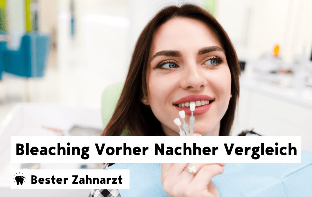 Bleaching Vorher Nachher Vergleich und Kosten