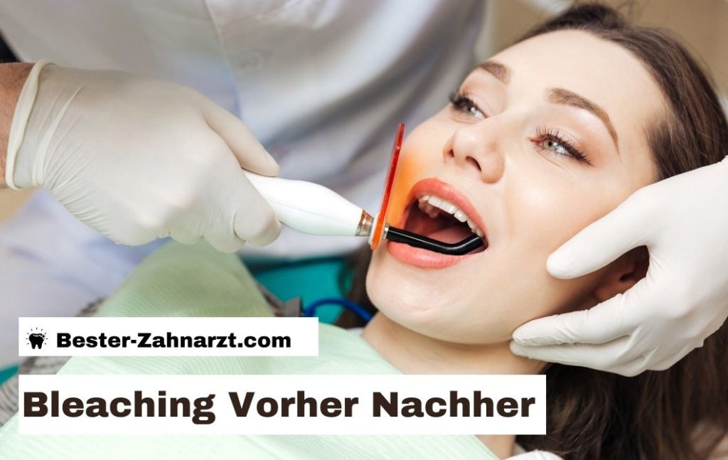 Bleaching Vorher Nachher Vergleich und Kosten